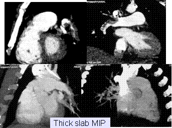 Pulmonary Thromboembolism Imaging